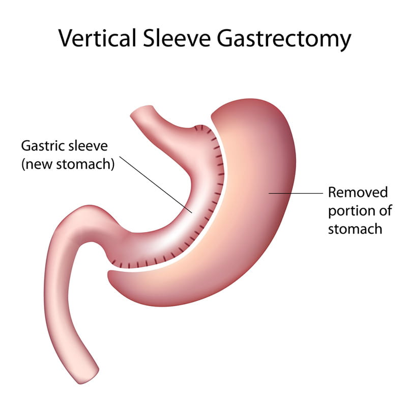 Gastric Sleeve Surgery Gold Coast | Dr Mastakov