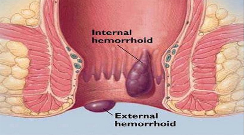 Haemorrhoidal Artery Litigation