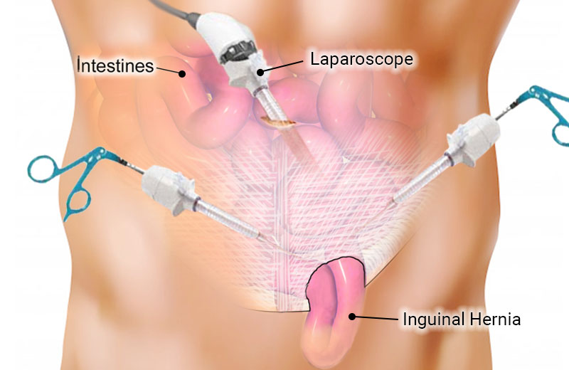 Hernia Repair Surgery