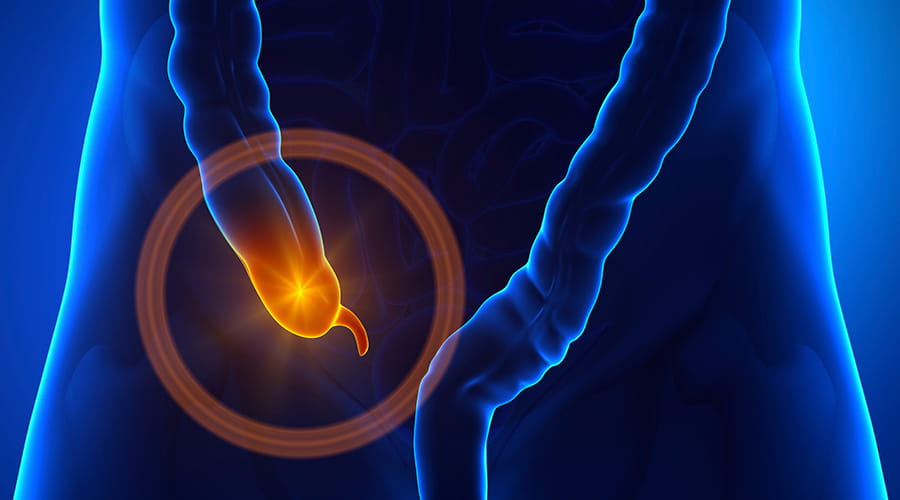 Appendectomy