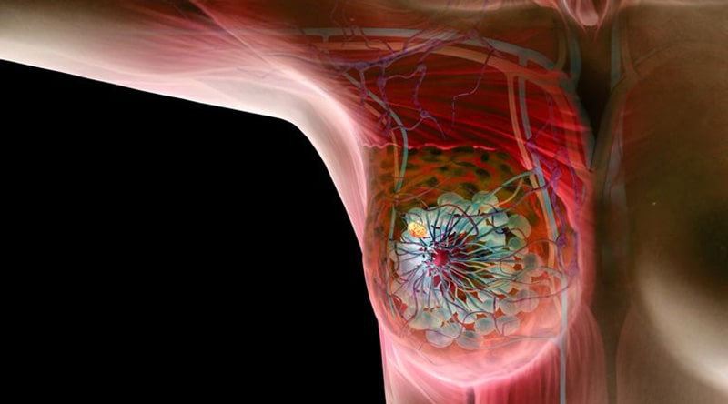 Benign or Malignant Breast Conditions
