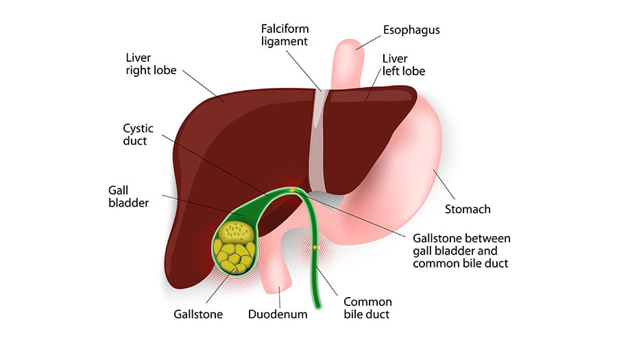 Cholecystectomy