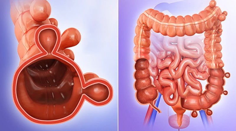 Diverticulitis