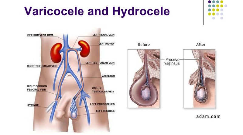 Hydrocele and Varicocele