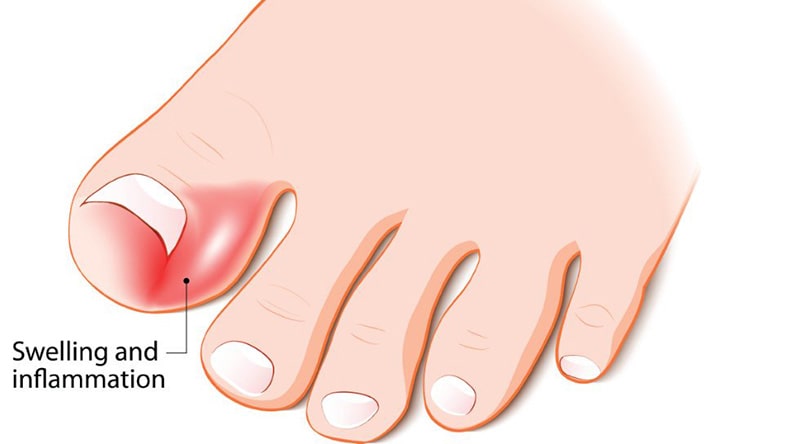 Ingrown Toenails