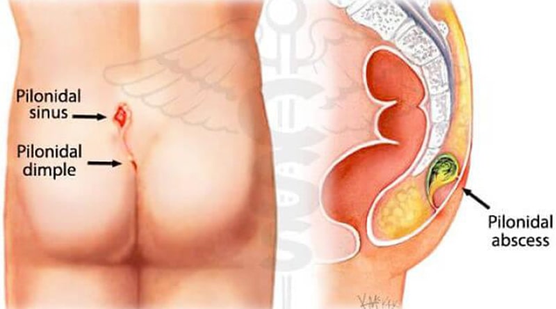 Pilonidal Sinus
