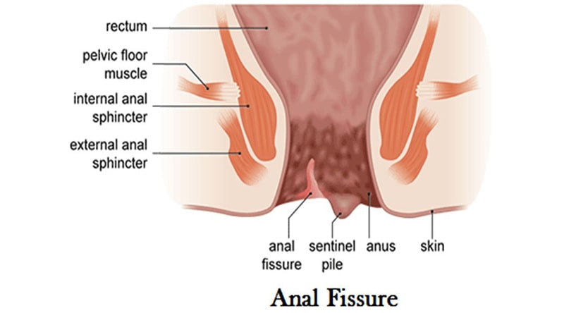 Surgery for Anal Fistula or Fissure
