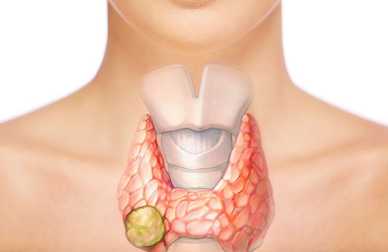 Thyroid and Parathyroid Pathology