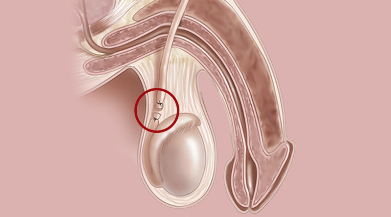 Vasectomy Brisbane & Hervey Bay