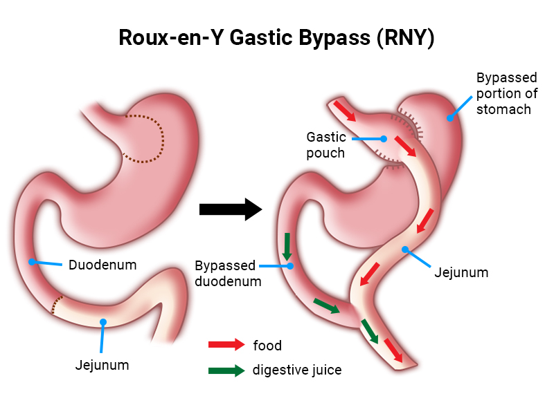 Gastric Bypass (Roux-en-Y) — Brisbane Clinics